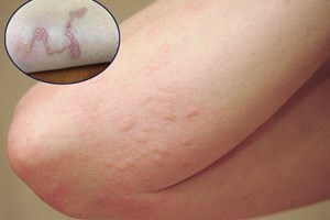 Dấu hiệu thường gặp khi nhiễm Sán Chó